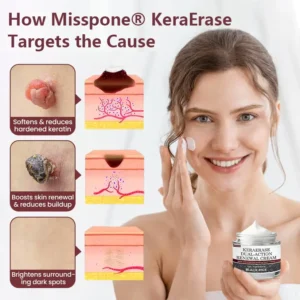 Misspone® KeraErase Dual-Action Renewal Cream